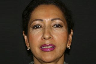 Ohren anlegen Bild nach OP 2